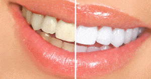 teeth-whitening