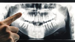 Dentist pointing to wisdom tooth problem on dental X-ray
