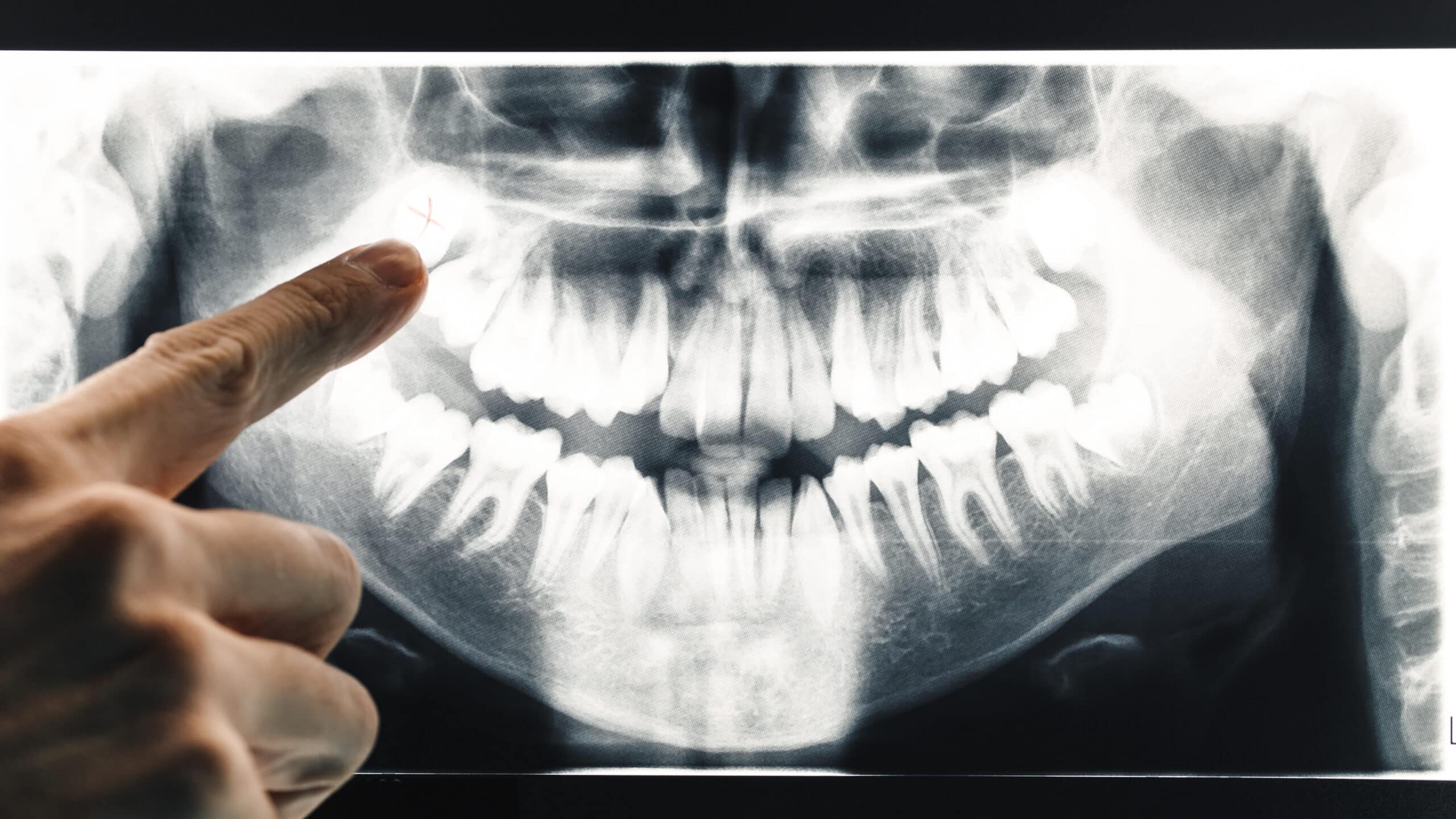 The 8 Hidden Signs Your Wisdom Teeth Need to Come Out