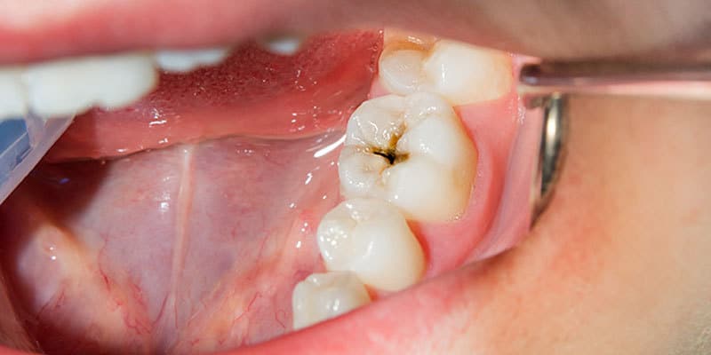 dental caries