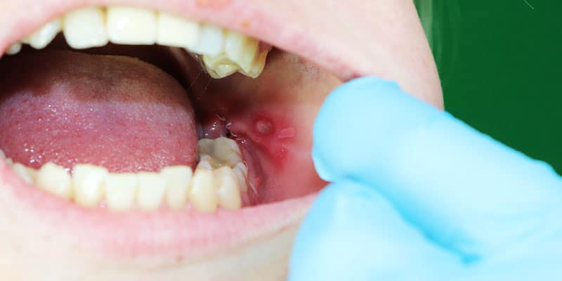 mouth canker sores