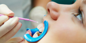 dental sealant procedure