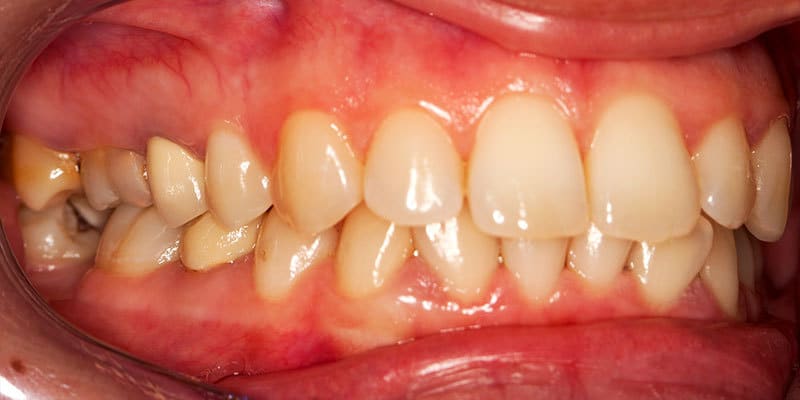 The 5 Stages of Gum Disease: Signs, Symptoms, and Treatment - Old